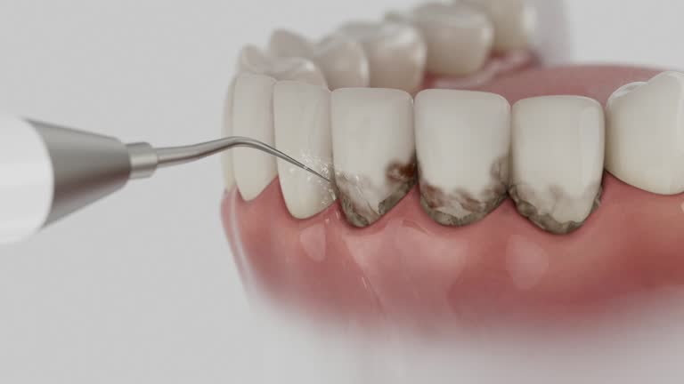 Trusted Wisdom Tooth Removal service in Governors Club, NC - Dentist Open Now